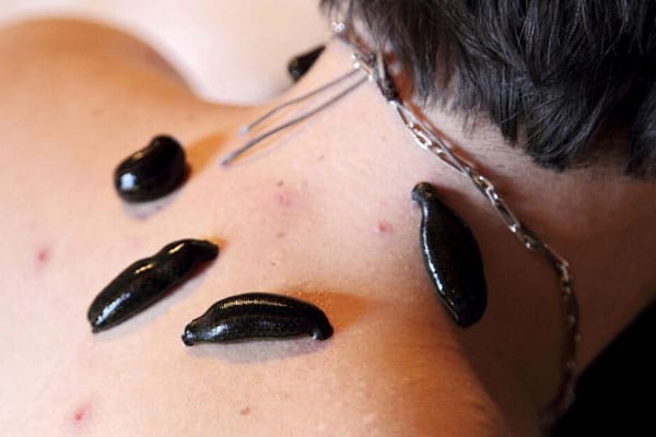 Leech Therapy